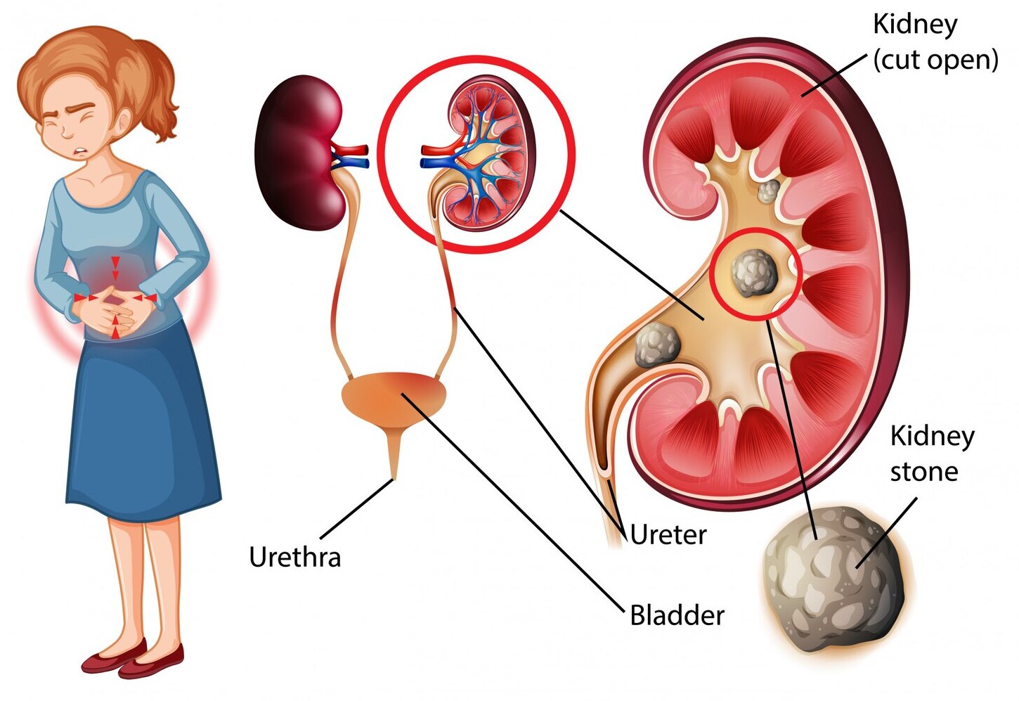 Kidney / Ureter / Bladder Stone Problems