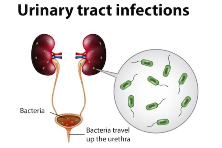 Urinary Infection