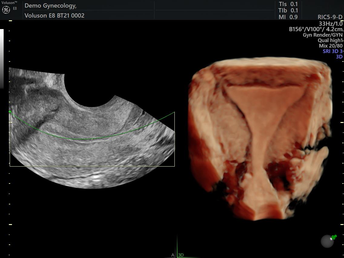 Transvaginal Ultrasound