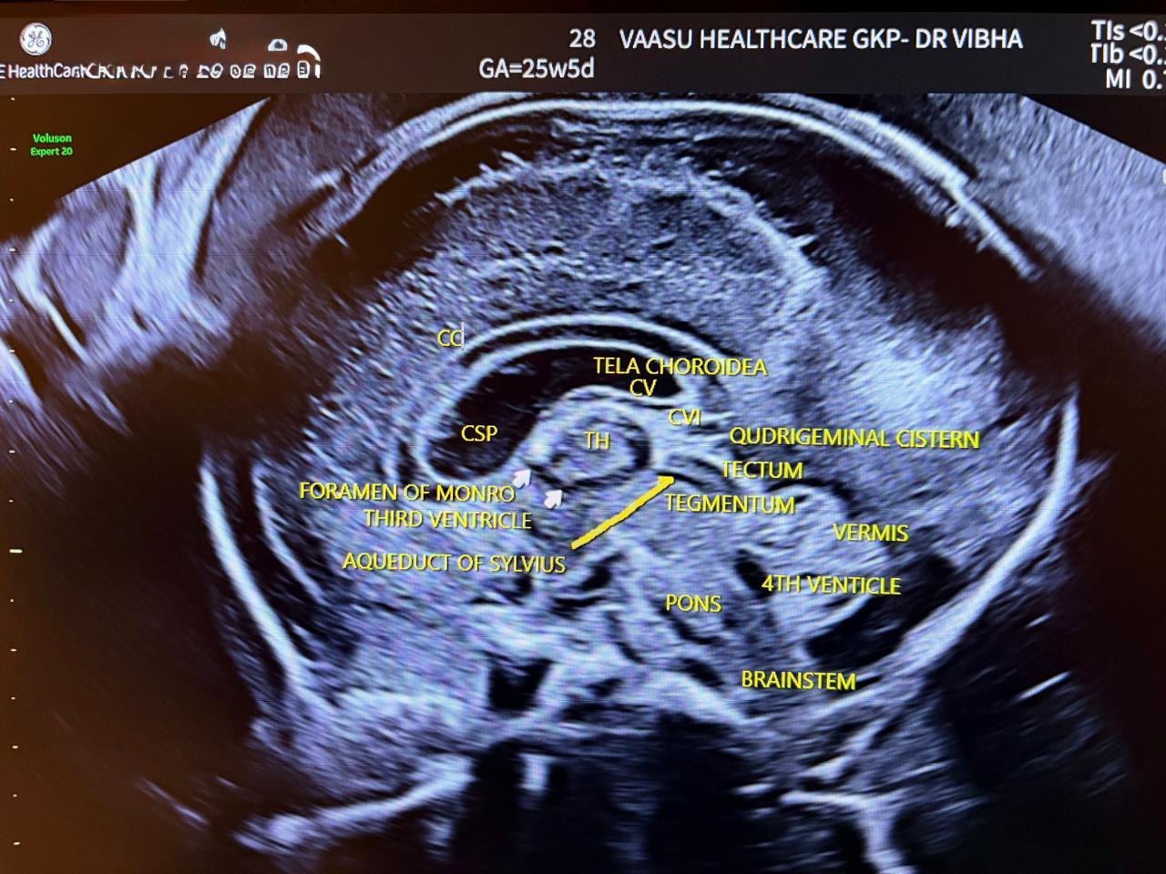 Fetal Neurosonogram